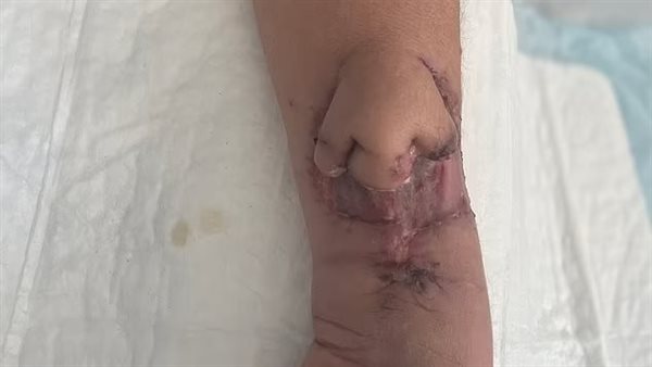 زراعة أنف على يد