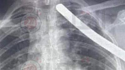 3 جراحين وعملية لمدة ساعتين.. تفاصيل استخراج سيخ حديد من جسد عامل بناء بقصر العيني