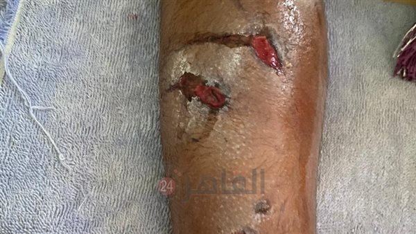 كلب شرش يعقر طالب