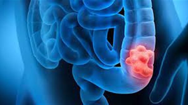  سرطان القولون