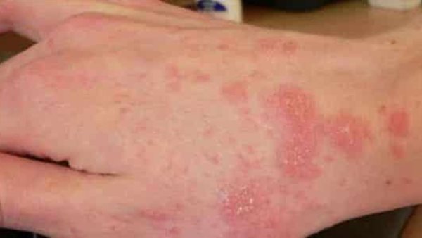 فيروس نقص المناعة