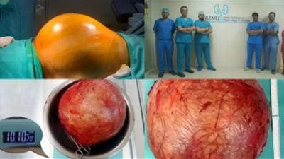 احتل ثلثي تجويف البطن.. أطباء ينجحون في إزالة ورم بحجم الكرة في كُلية رجل هندي