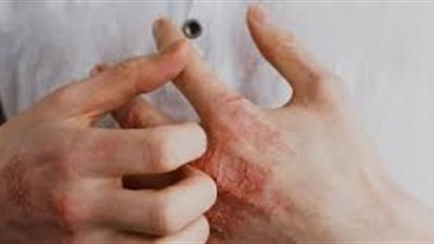 لأول مرة.. ظهور إصابة بالسعفة المنقولة جنسيًا في الولايات المتحدة