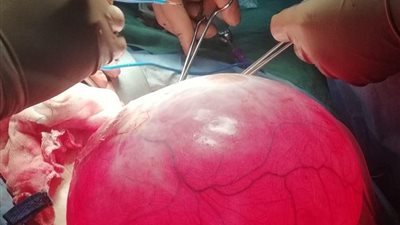 استئصال ورم يزن 15 كجم من مبيض سيدة في كفر الشيخ