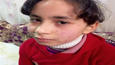 معلمة تتعدى على طفلة بالضرب وتُشوِّه وجهها في كفرالشيخ.. والتعليم ترد