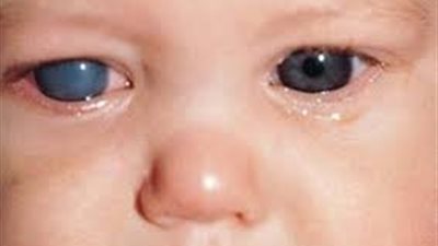 اكتشاف طفرة جينية وراء الجلوكوما المسببة لفقدان البصر في مرحلة الطفولة | دراسة