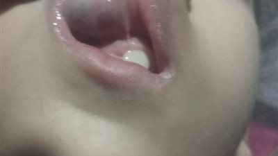 مأساة حنين.. زميلاتها يتنمرن عليها بسبب ورم ونزيف شفتها 