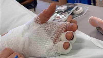 إنقاذ يد مريض من البتر في مستشفى السنبلاوين العام بالدقهلية