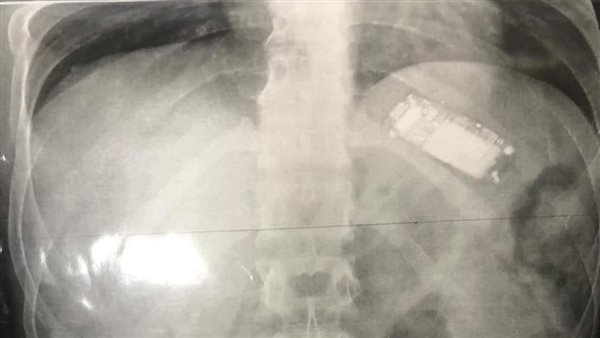 تليفون محمول في معدة