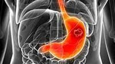 أعراض مبكرة تشير لخطر الإصابة بسرطان المعدة