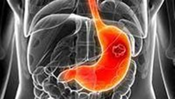 سرطان المعدة