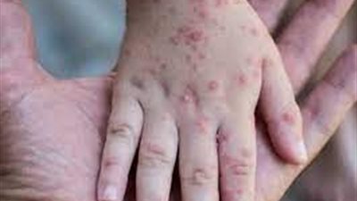 جدري القرود يصل أوروبا.. ومخاوف عالمية من انتشار الفيروس | بث مباشر 