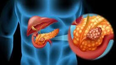القاتل الصامت.. تعرف على أعراض سرطان البنكرياس