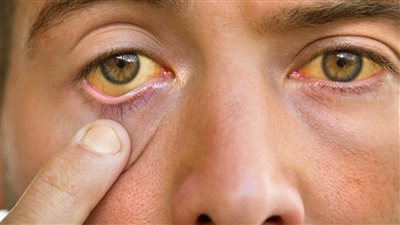 اصفرار العين واضطرابات النوم أبرز علامات تليف الكبد