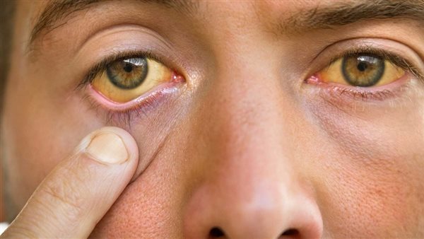 علامات تليف الكبد