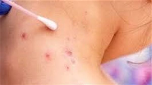 جدري القرود