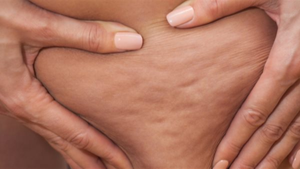 السيلوليت في النساء