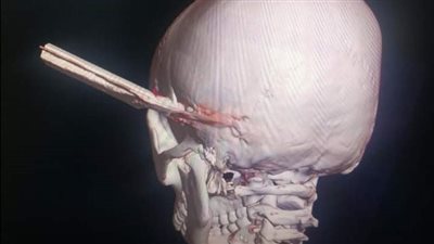 مستشفيات جامعة المنصورة تنجح في استخراج آلة حادة اخترقت رأس مريض 