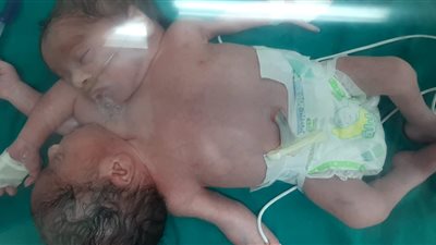 نجاح ولادة توأم ملتصق من البطن بمستشفى جامعة المنصورة