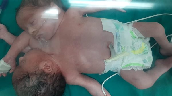 نجاح عملية ولادة