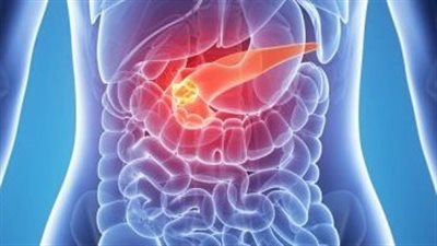 احذر.. 10 علامات تدل على إصابتك بسرطان البنكرياس