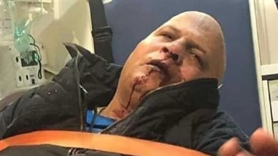 إصابة عادل شكل في سقوط مدرج مباراة الأهلي والاتحاد السكندري.. وارتفاع عدد المصابين لـ 27 شخصًا | بث مباشر