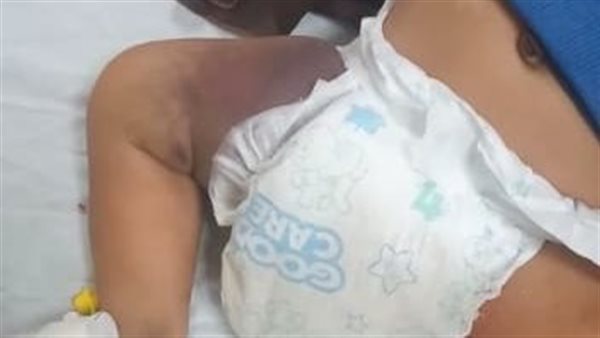 الطفل المصاب نتيجة