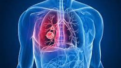 تحذير صحي بعد تفشي مرض رئوي خطير في أمريكا