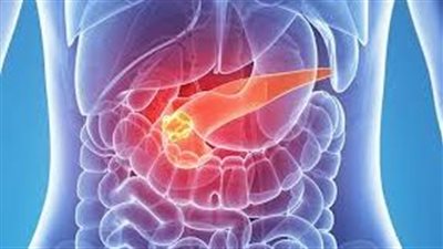 باحثون يكتشفون بروتينا لتشخيص وعلاج سرطان البنكرياس| دراسة