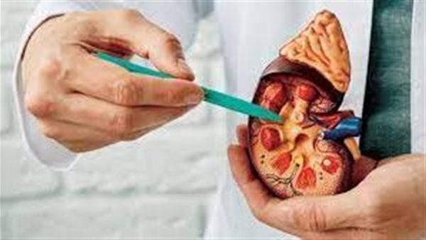  حصوات الكلى