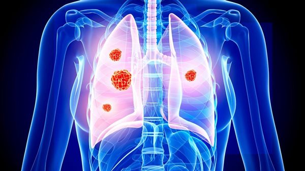  سرطان الرئة