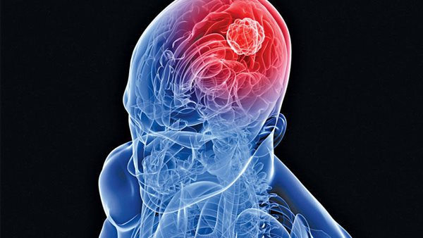 سرطان الدماغ