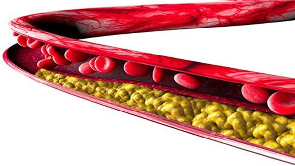 دهون الدم - تعبيرية