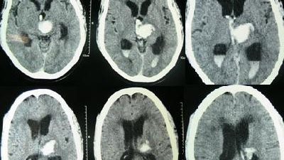 شقيق مصاب بنزيف في المخ يستغيث لطلب قسطرة علاجية على المخ 