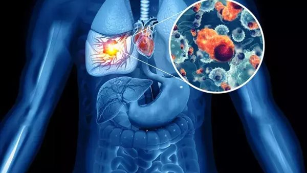 سرطان الرئة - أرشيفية