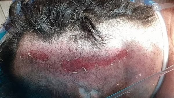 الإصابة بصاعقة برق