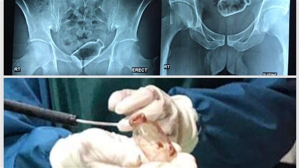 استخراج زجاجة من