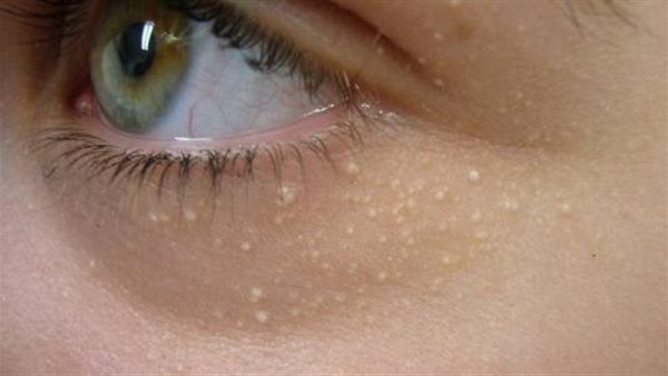 الرؤوس البيضاء