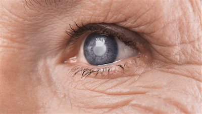 6 إنذارات مبكرة للجلوكوما.. جراح عيون يحذر: لا تتجاهلها