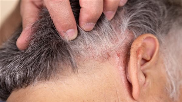 عدوى السعفة 