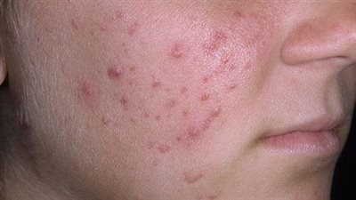 أبرزها حب الشباب.. تغييرات جلدية تشير إلى الحالة الهرمونية بالجسم