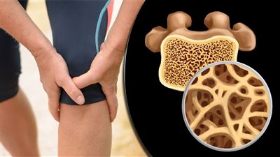 دراسة توضح الآثار الجانبية لأحد أدوية هشاشة العظام