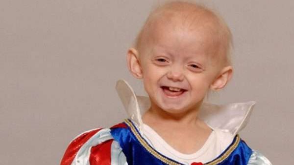 متلازمة فيرنر 