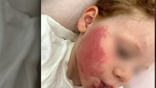 طفل يصاب بحروق