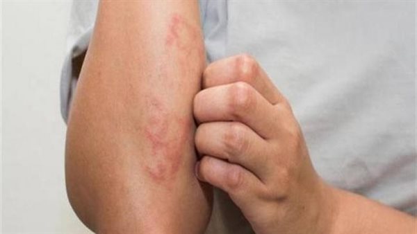 علامة الإصابة بالسرطان