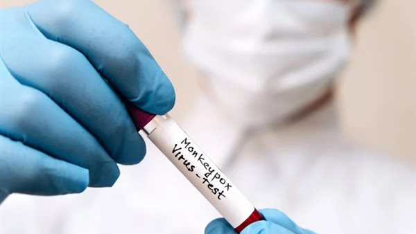 جدري القرود