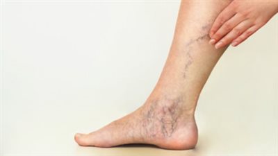 أسباب الإصابة بدوالي الساقين.. الجلوس لفترات طويلة أبرزها