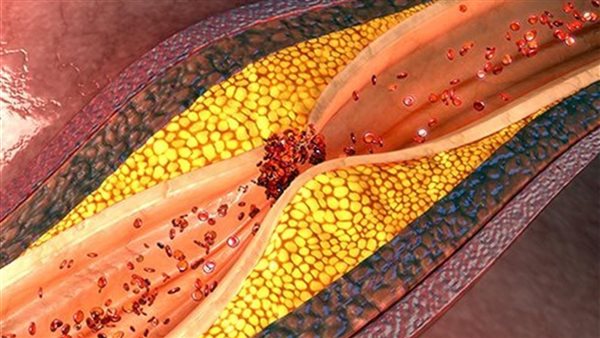تراكم الدهون في الشرايين