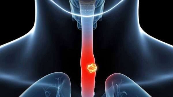 سرطان المريء