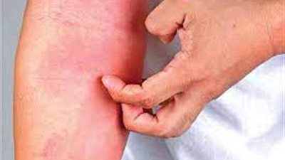 علامات الإصابة بالتهاب الجلد الضوئي النباتي.. احذر منها